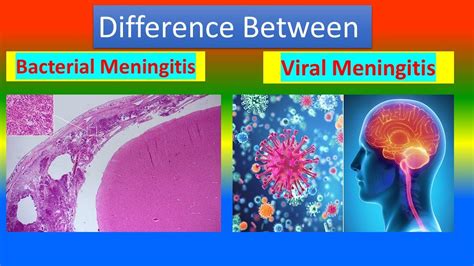 bacterial meningitis source of infection